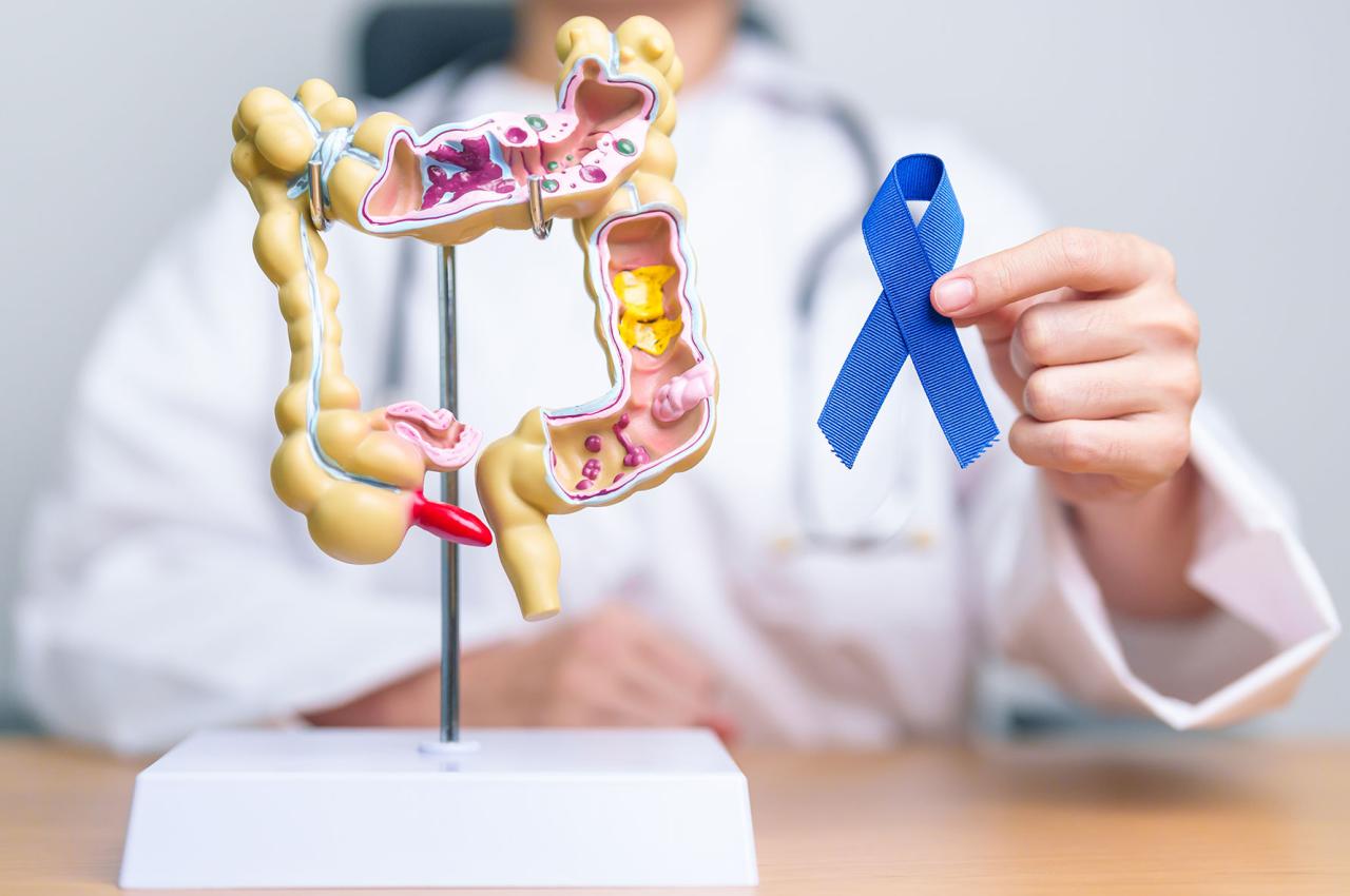 A doctor holds a model of the human colon and a blue ribbon 